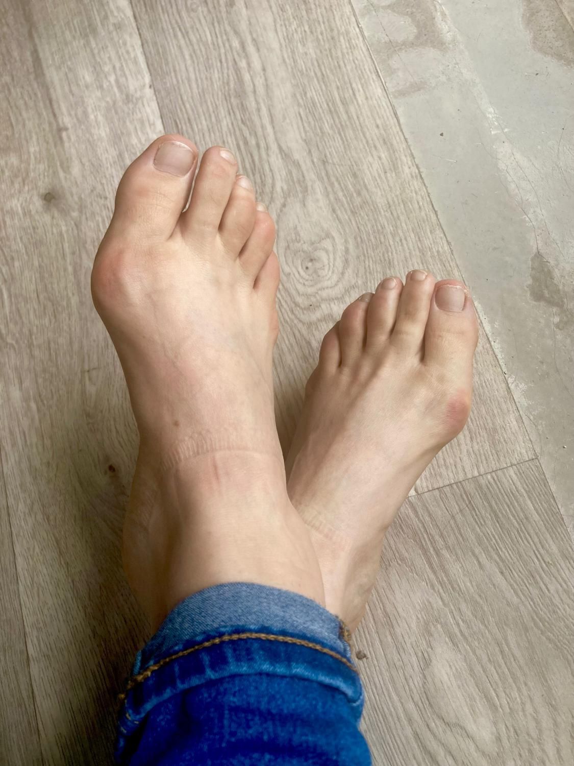Halluxvalgusfeet's media